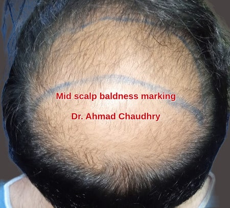 Mid scalp baldness marking