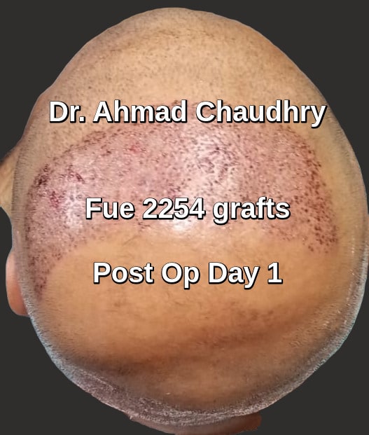 Top view mid scalp hair restoration day one
