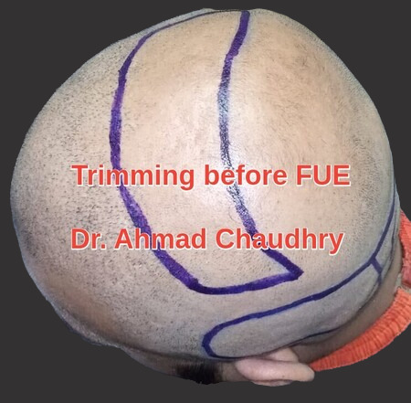 Trimming and shaving before Fue procedure
