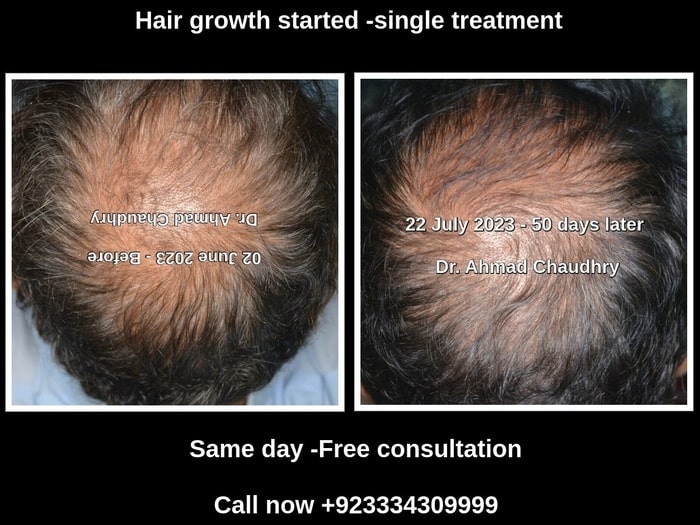Hair growth treatment result Lahore