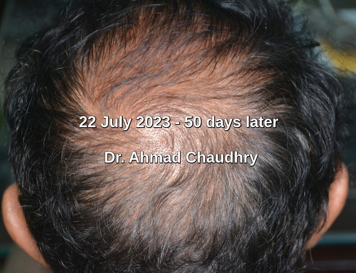 Hair regrowth results 50 days later