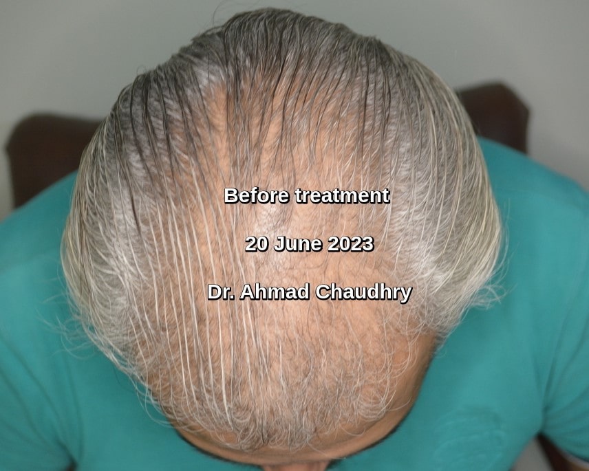 Before PRF hair treatment Lahore Pakistan