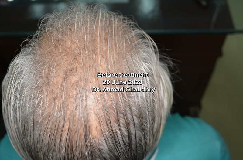 Crown area before regrowth therapy