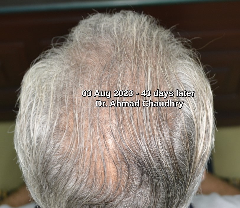 Crown hair growth after PRF therapy results
