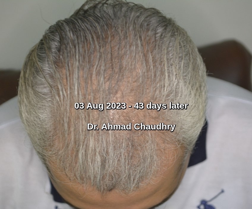 PRF hair regrowth treatment result
