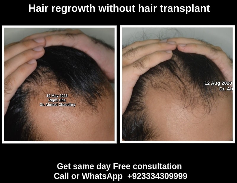 Regrow hair without hair transplant