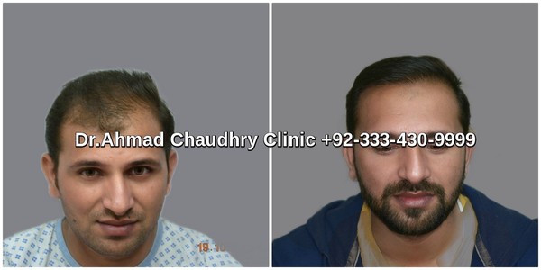 Androgenetic Alopecia before after surgery Lahore